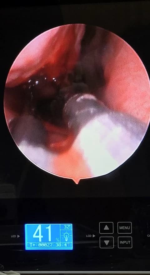 Radiofrequency Turbinate Reduction (RF Turbinoplasty) ENT specialist performing radiofrequency turbinate reduction (RF Turbinoplasty) to treat chronic nasal obstruction at RAJVITHI CLINIC.