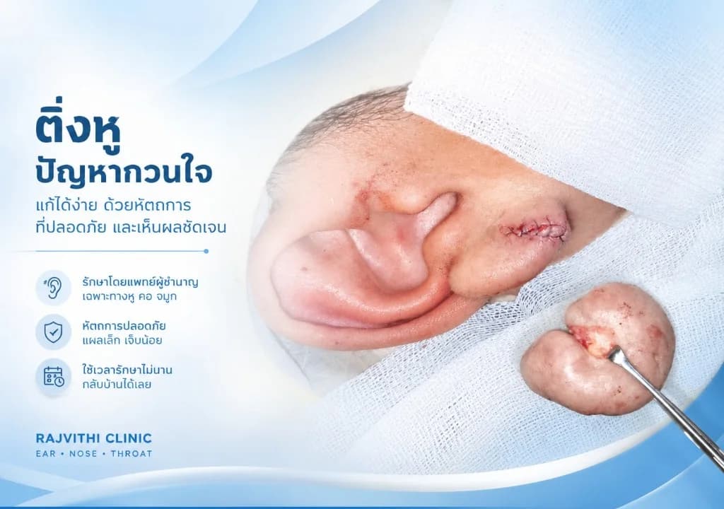 Ear Keloid Excision Surgery | RAJVITHI CLINIC ผ่าตัดคีลอยด์ใบหูโดยแพทย์เฉพาะทางหู คอ จมูก พร้อมเย็บแผลอย่างประณีต ที่ราชวิถีคลินิก หู คอ จมูก เชียงใหม่