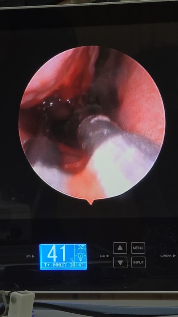 Radiofrequency Treatment